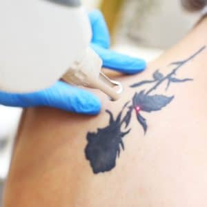Tatoeage verwijderen met de Pico Laser Spot bij Beautylink